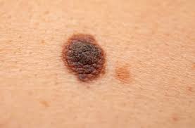 niepokojący pieprzyk