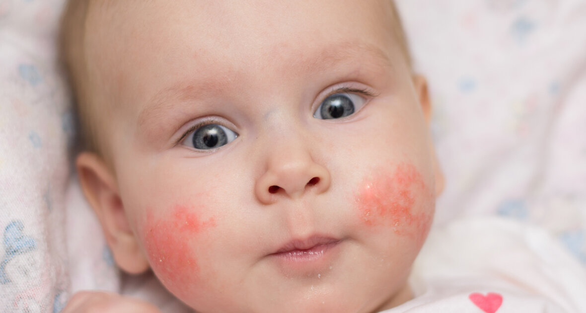 popękane naczynka u dziecka