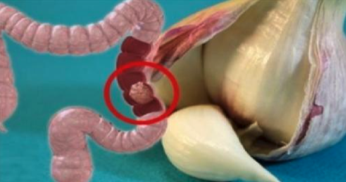 Przestrzegając tych 8 zasad, można by zapobiec ponad 50% przypadków raka okrężnicy.