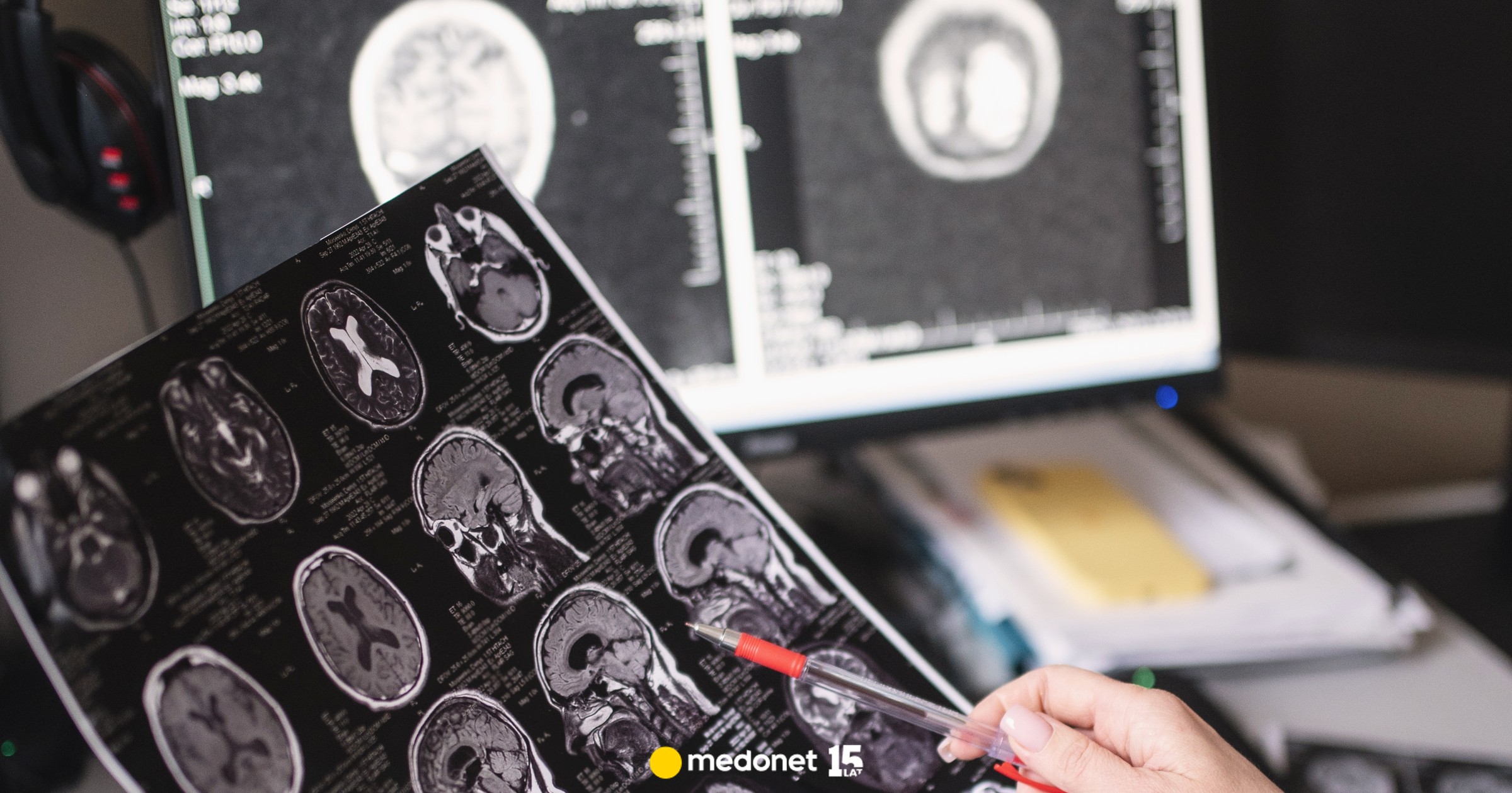 Po diagnozie pacjenci żyją średnio 10 lat. Choroba rozwija się w ukryciu