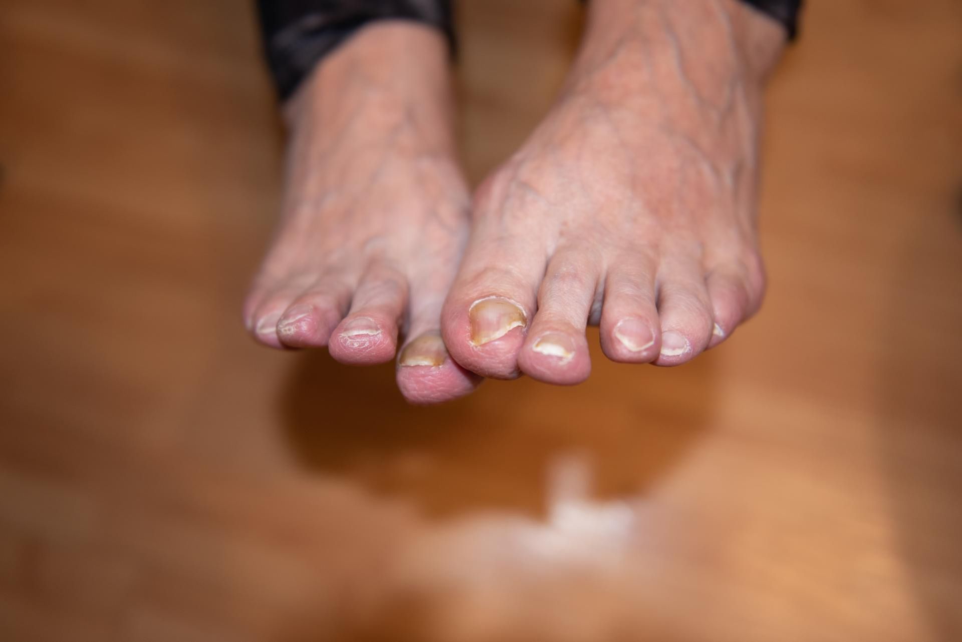 Subtelny objaw wysokiego cholesterolu pojawiający się podczas chodzenia