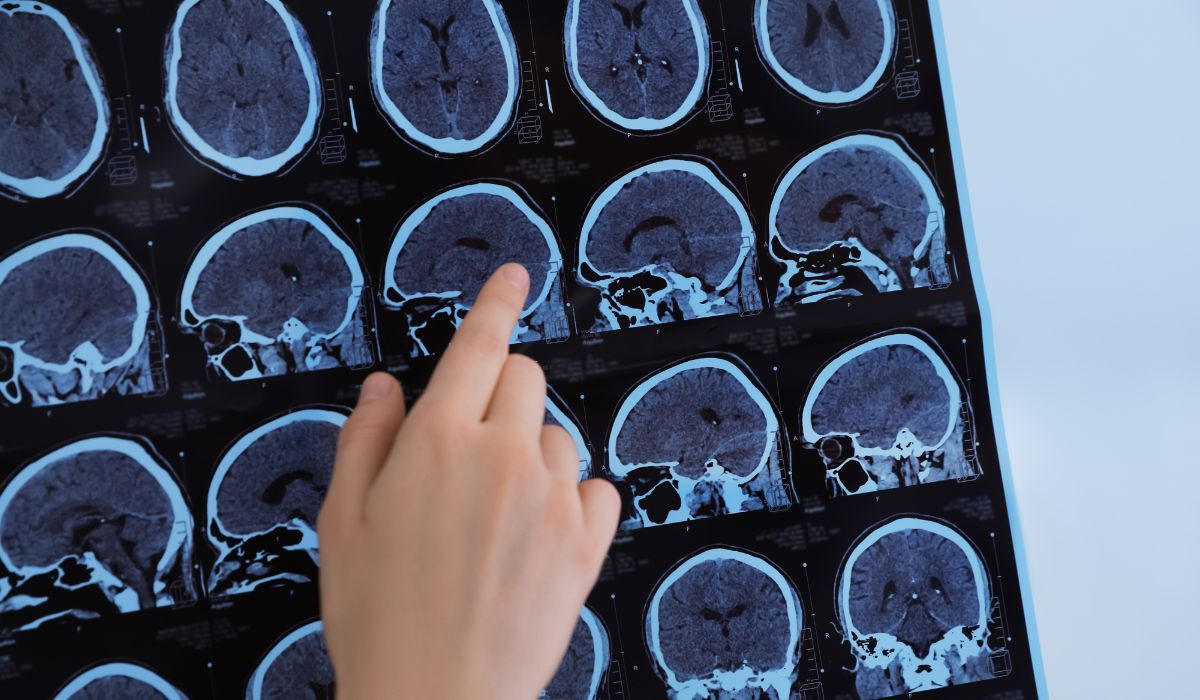 „Wysyp” udarów u coraz młodszych osób. Lekarze wskazują przyczynę