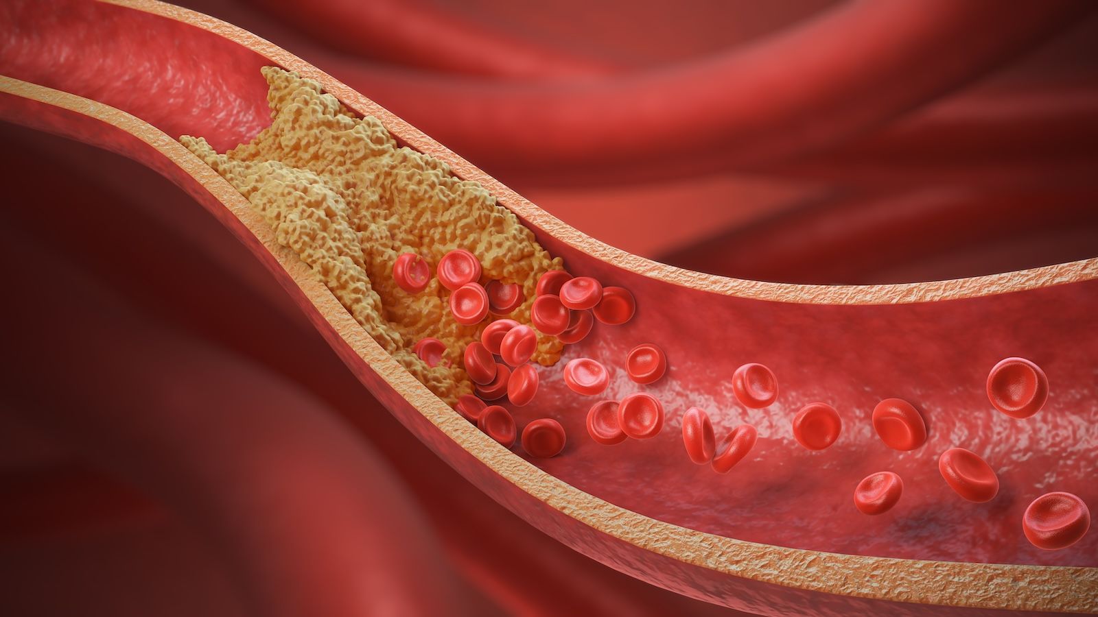 Nowe normy cholesterolu – serce choruje szybciej, niż myślisz