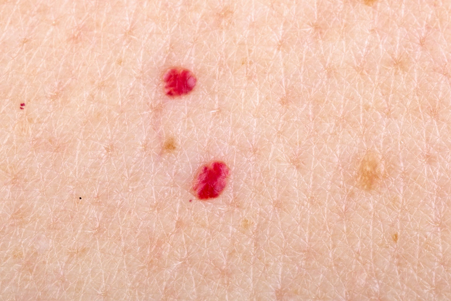 Czerwone „rubinki” na skórze — czym są naczyniaki rubinowe i kiedy iść do dermatologa